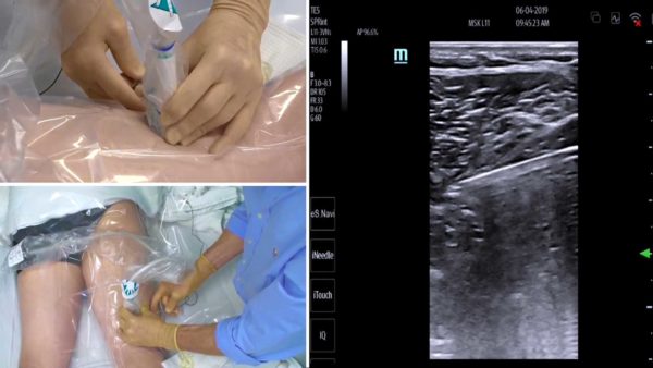 Ultrasound-Guided Peripheral Nerve Stimulation