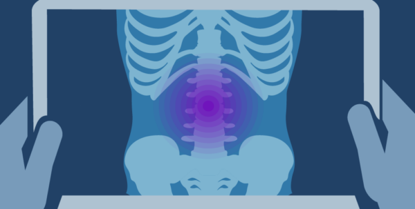 hands holding an x-ray of a human spine indicating low back pain